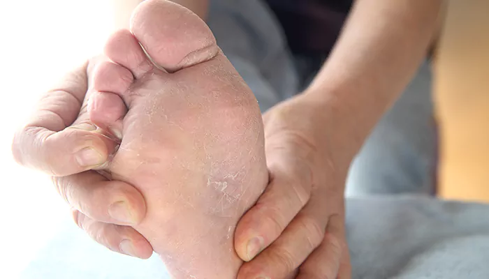 What To Do If Skin Starts To Peel On Your Feet?